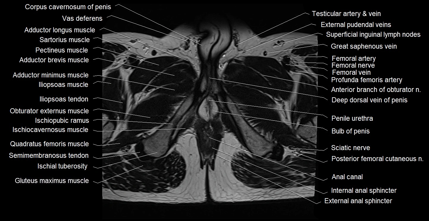 Male pelvis axial cross sectional anatomy image 42.webp